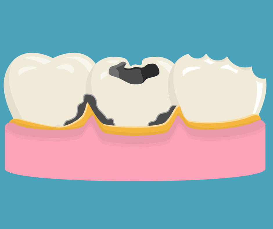 dental cavity