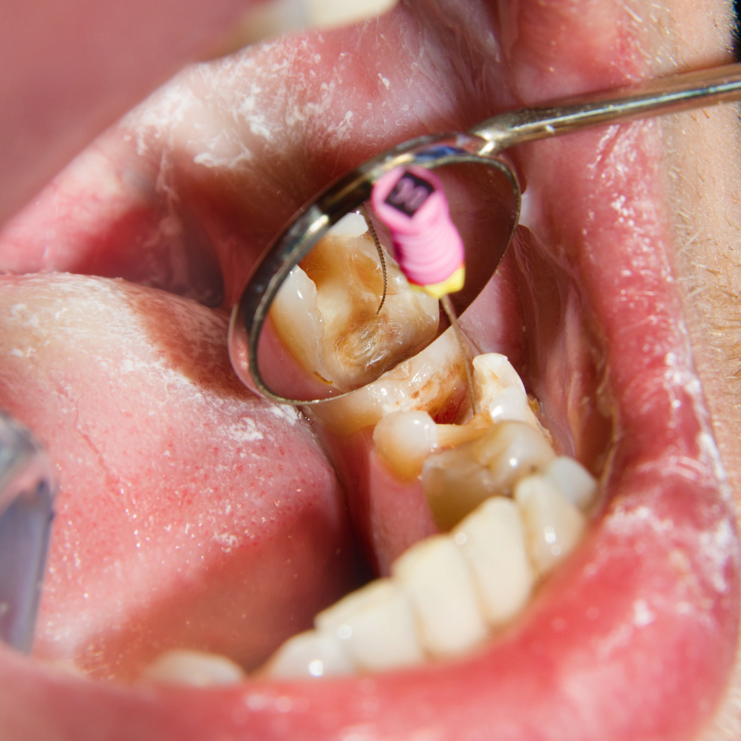 dental filling