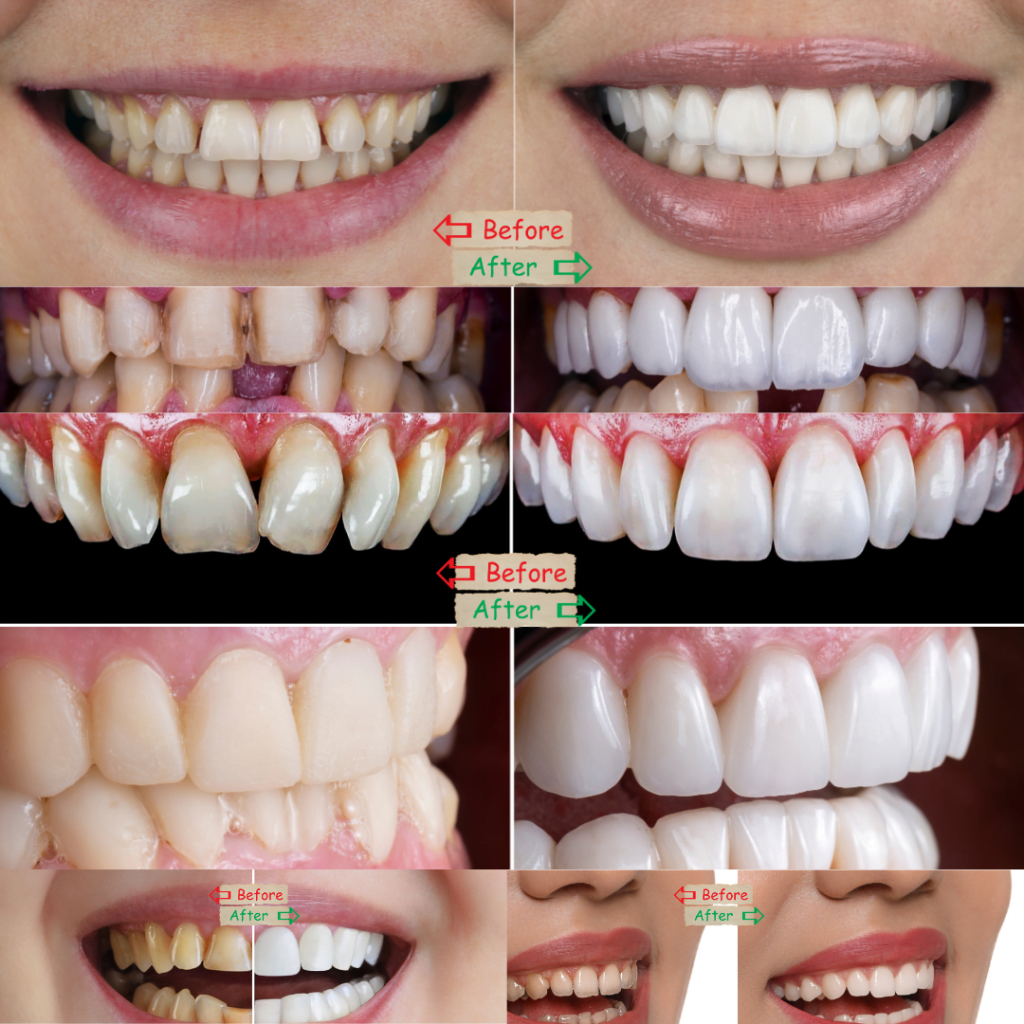 Before and After: Porcelain Veneers Effects