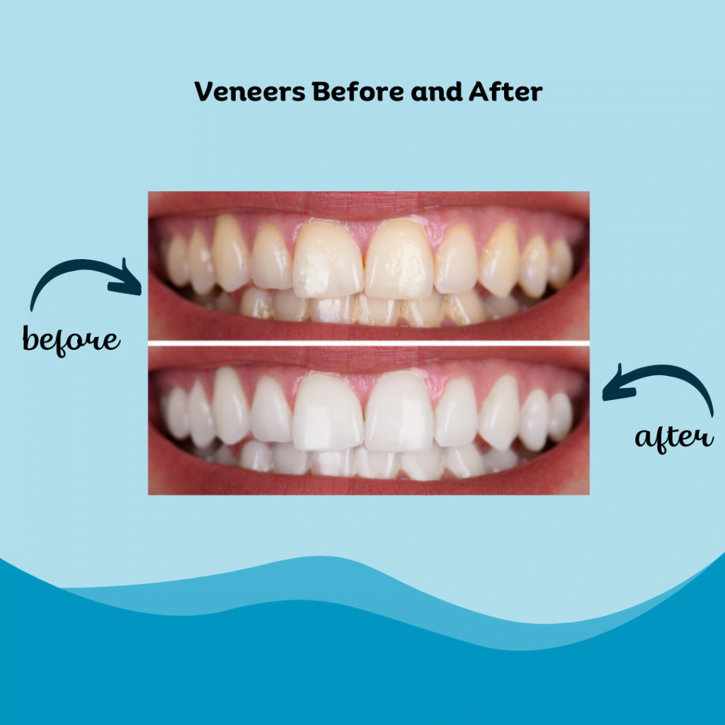 Veneers Before and After