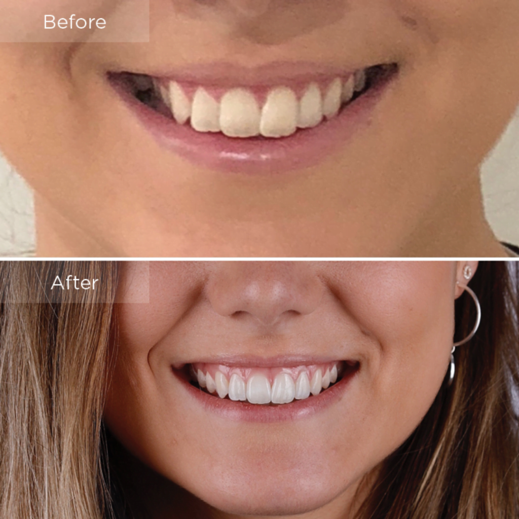 invisalign Before & After comparison