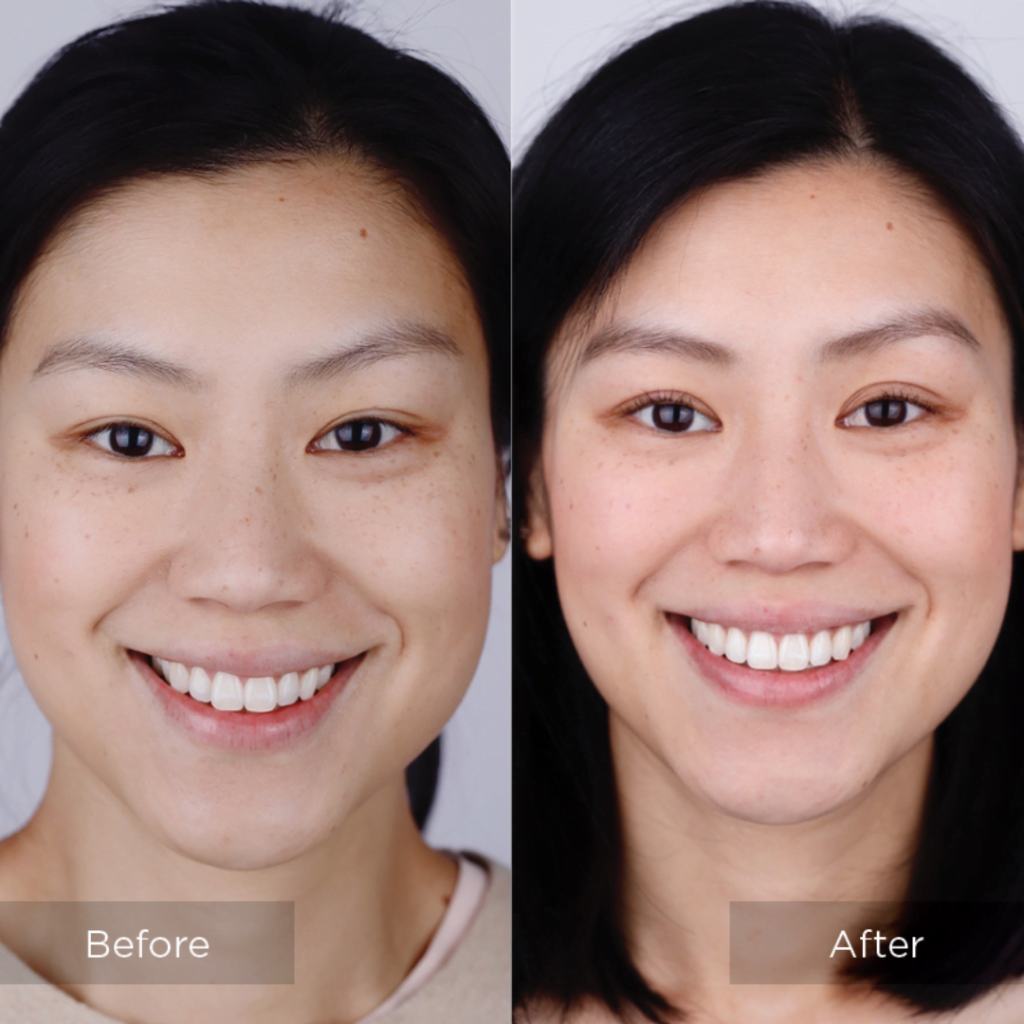 invisalign Before & After comparison