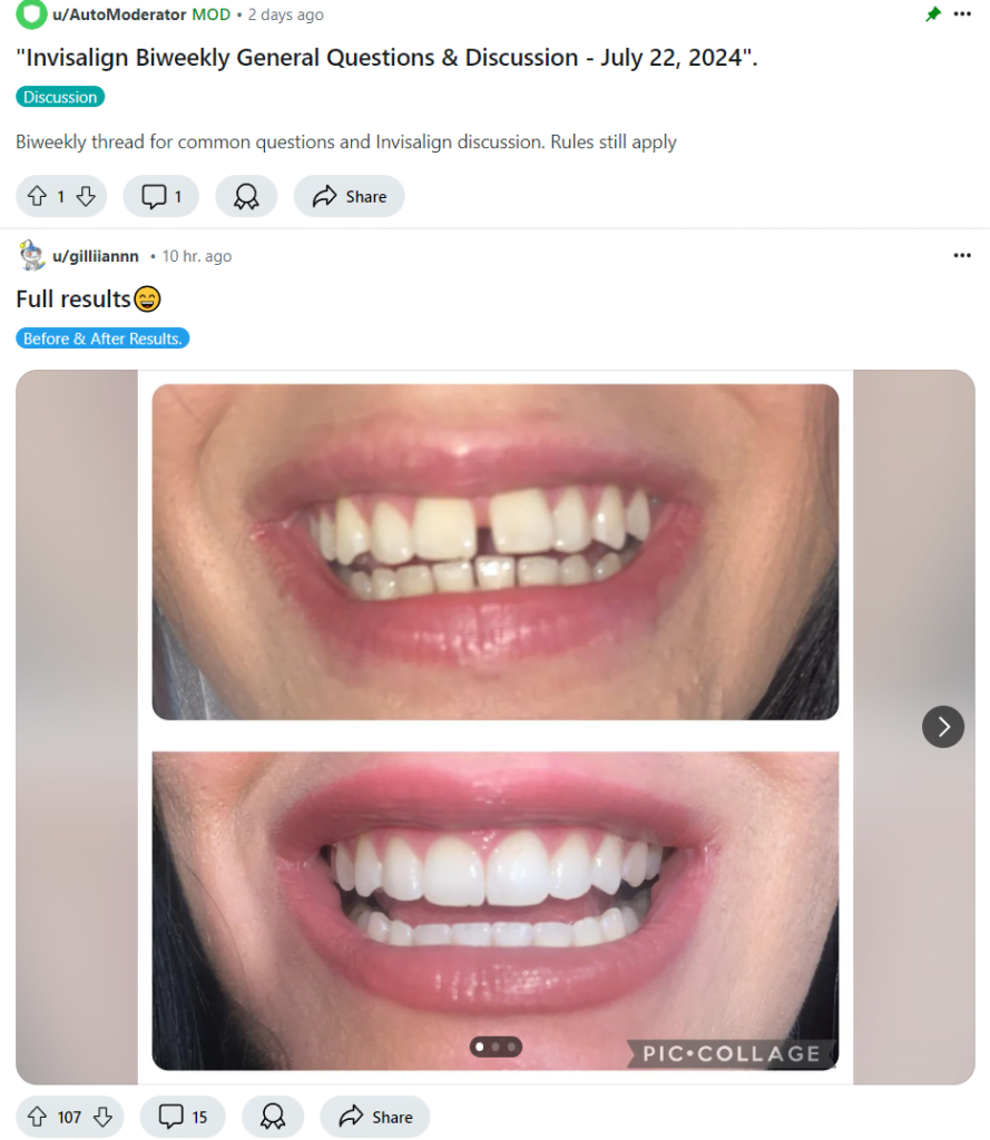 invisalign reddit