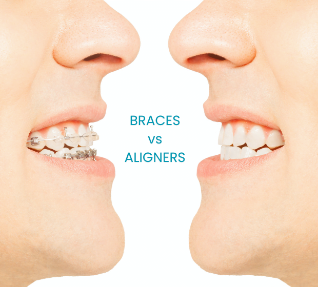 fixed braces vs aligners