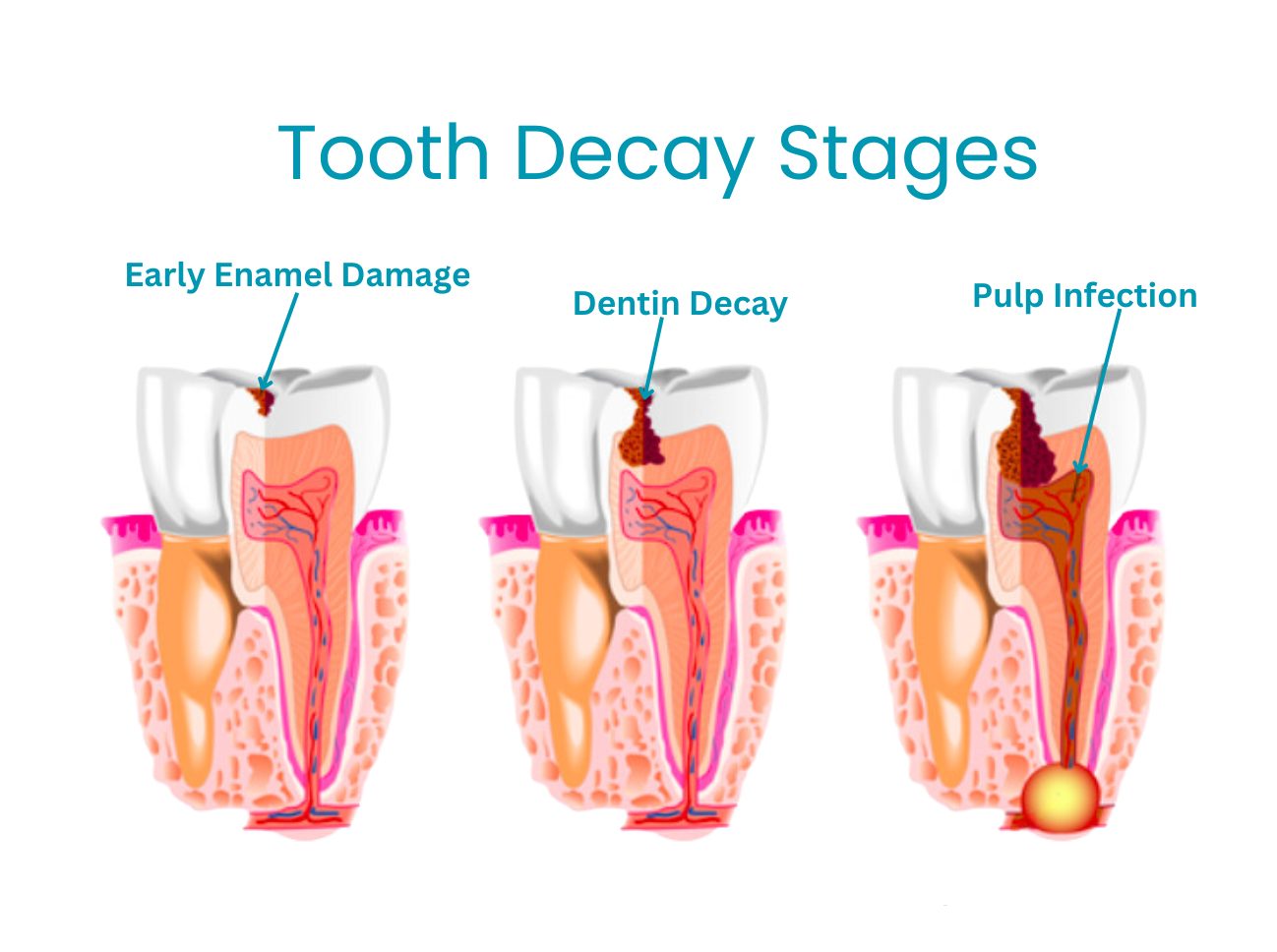 tooth decay stages